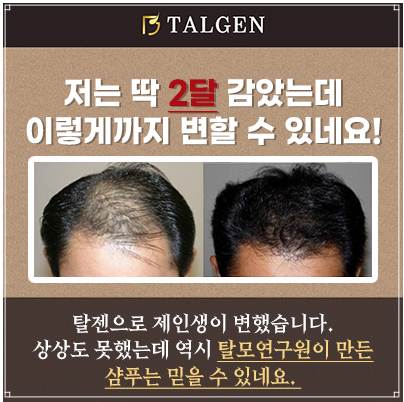 탈모